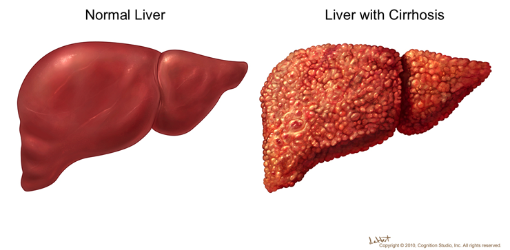 Liver Cirrhosis. Causes, symptoms, treatment Liver Cirrhosis