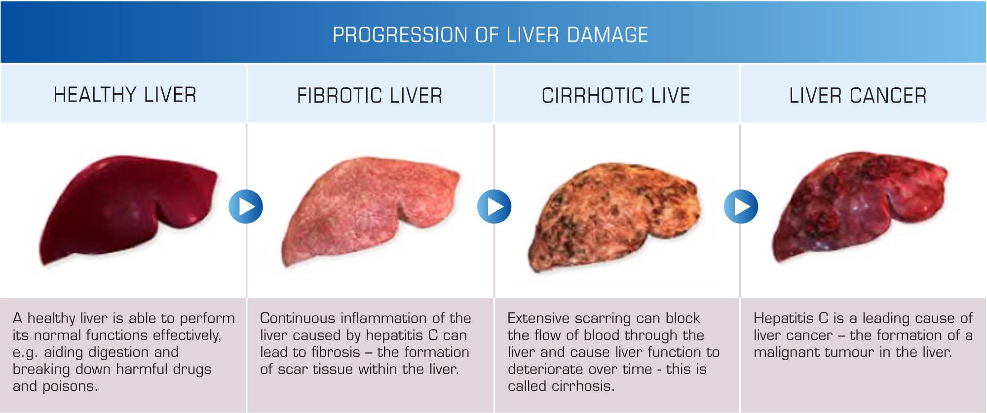 Liver cirrhosis curing in UCTC