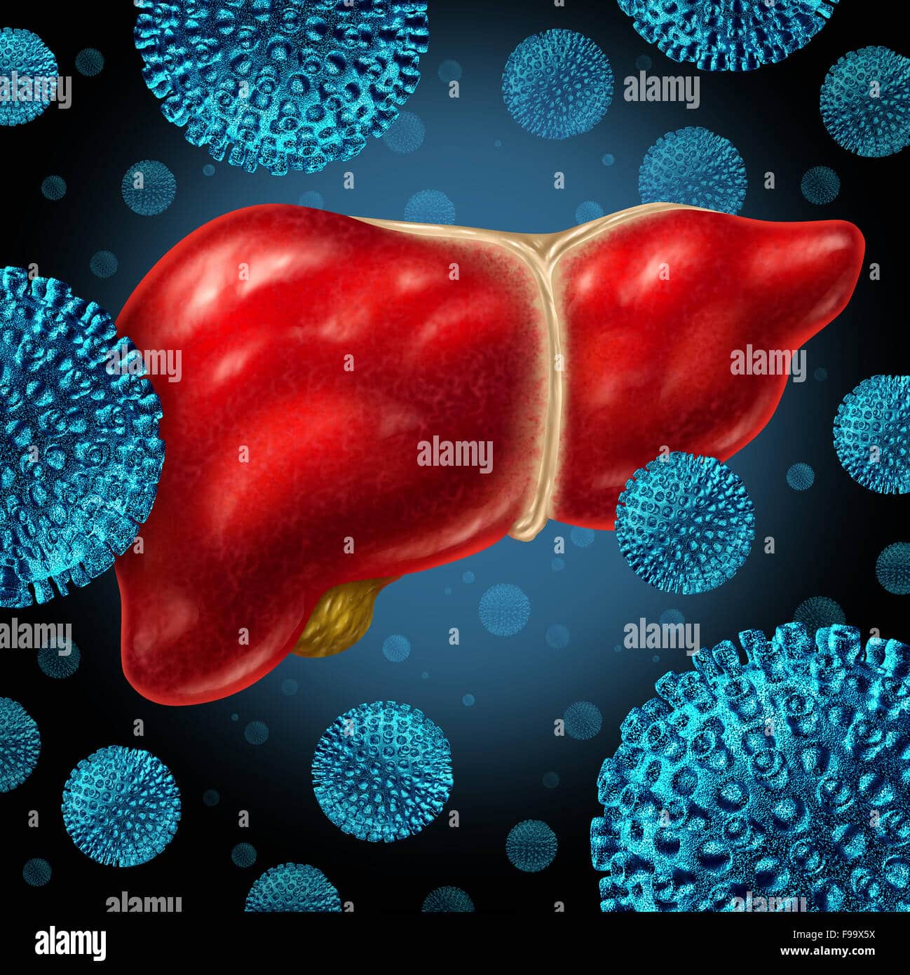 Liver Infection As A Human Liver Infected By The Hepatitis Virus As A ...