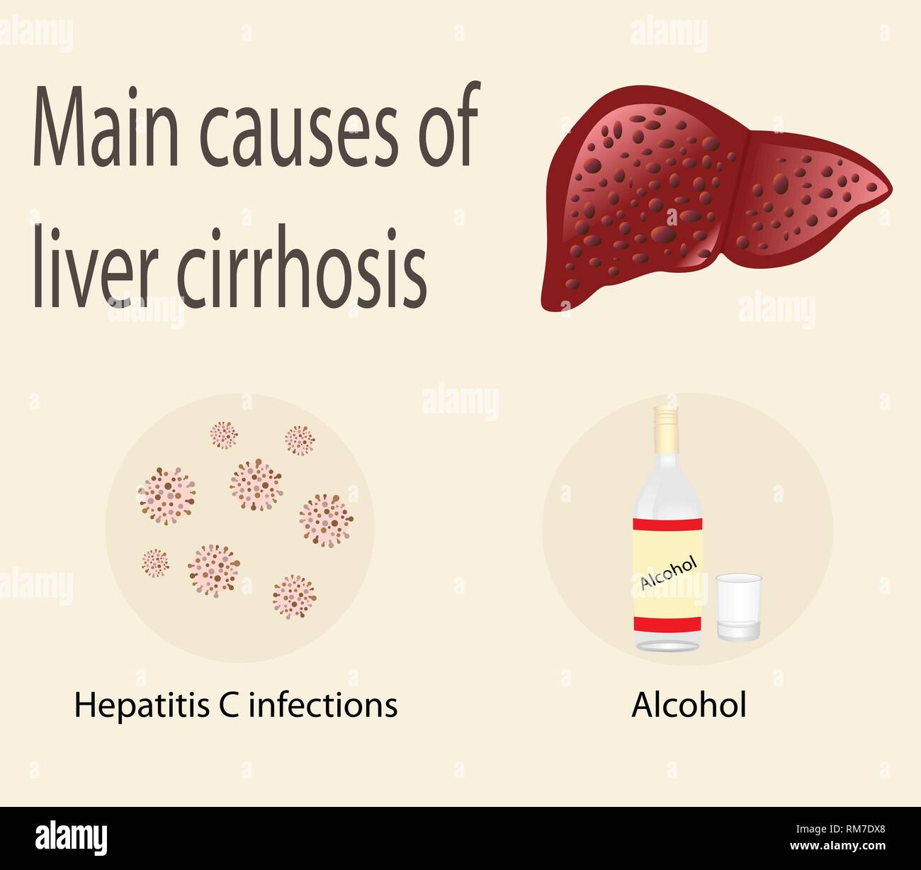 Main causes of liver cirrhosis hepatitis C infection and alcohol vector ...