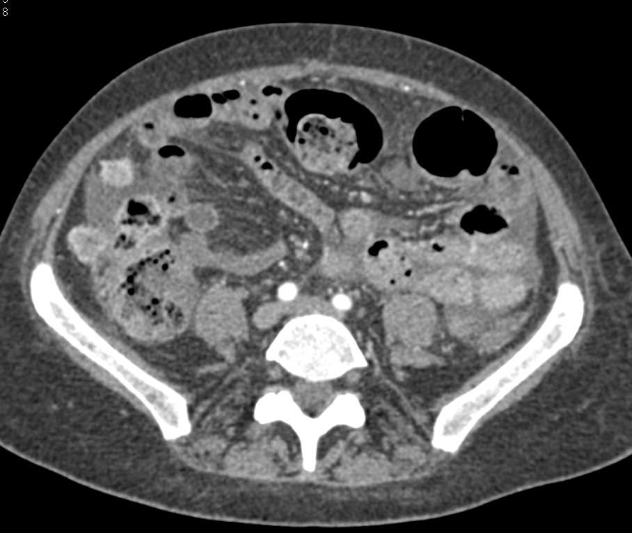 Metastatic Colon Cancer to Liver with Carcinomatosis