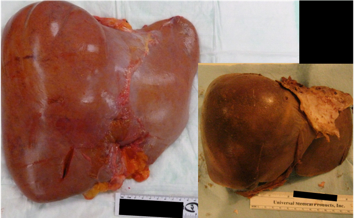 Monthly case â Congestive Hepatomegaly