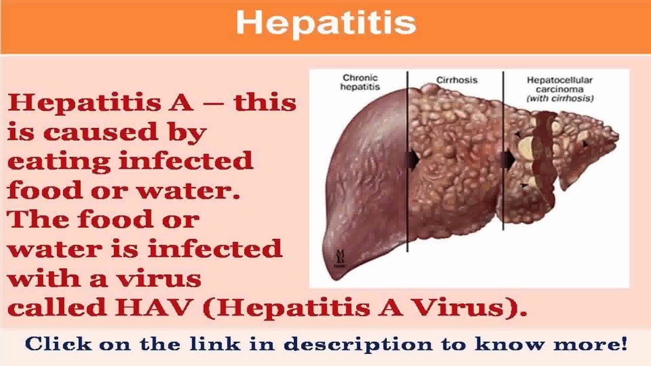 See now how to get rid of hepatitis b