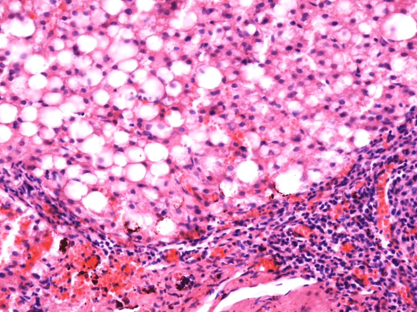 Severe steatosis associated with intense necroinflammatory ...