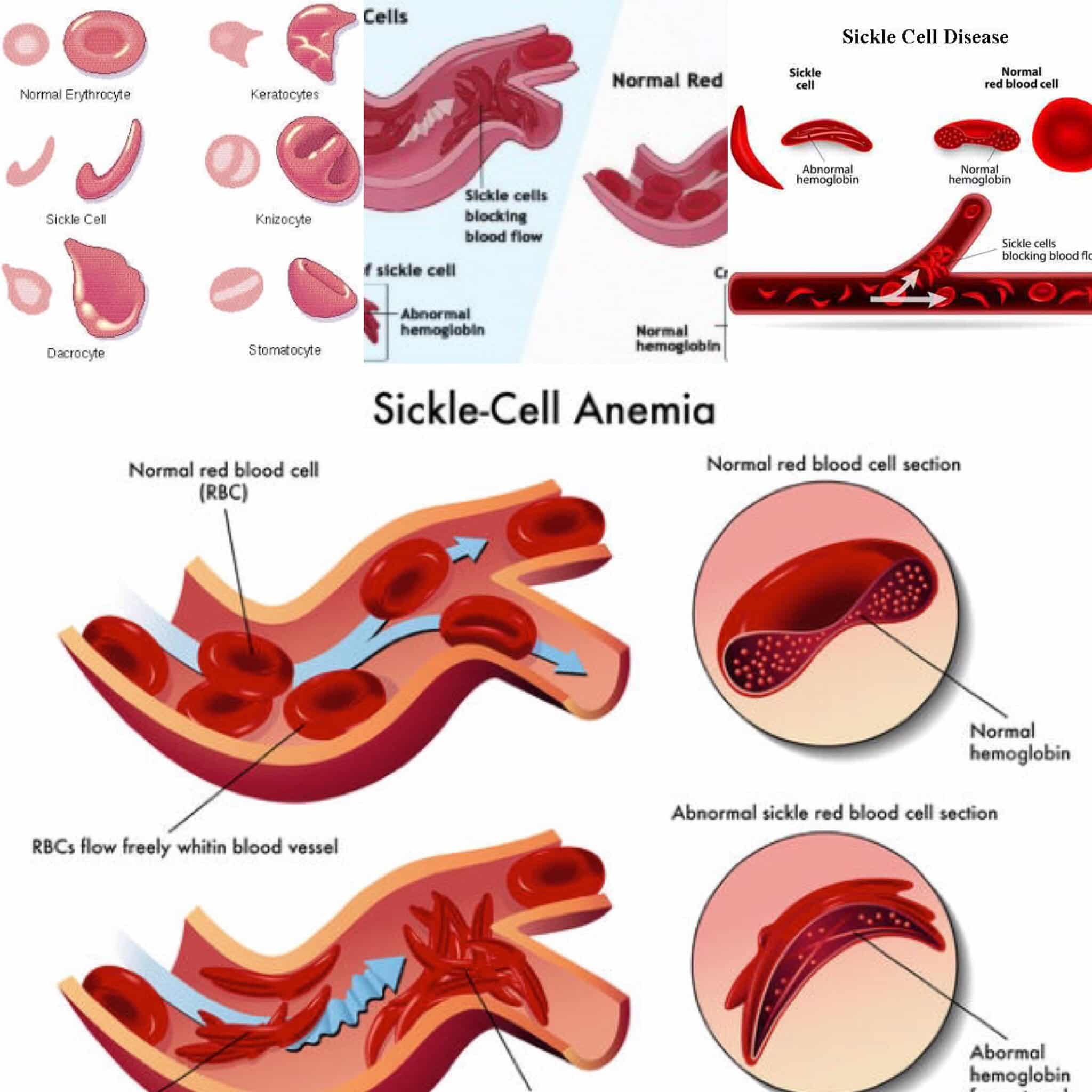 Sickle Cell Natural Healing. Post by ~ Anthia Lee