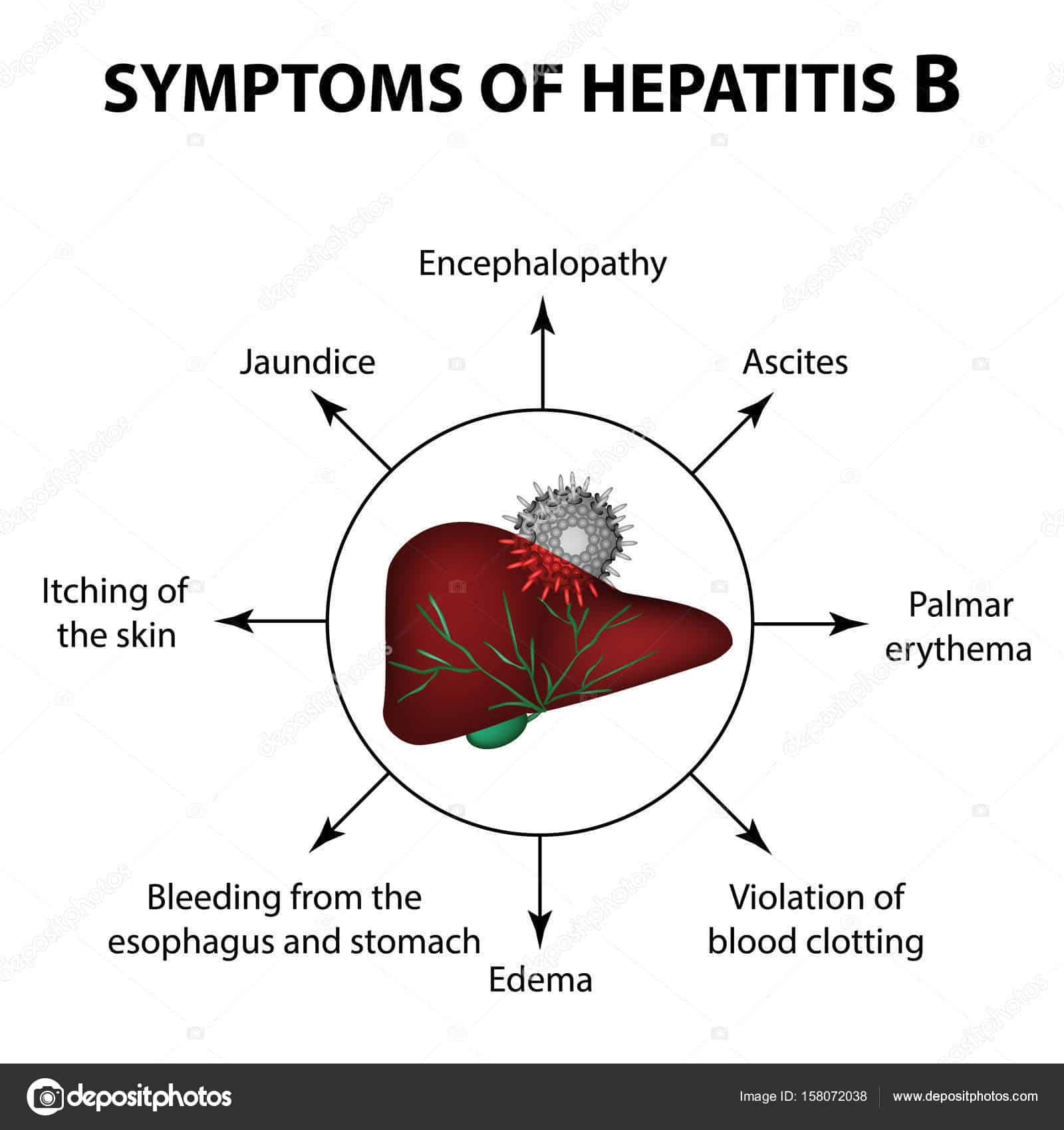 Sign And Symptoms Of Hepatitis B
