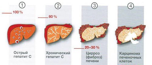 Signs of hepatitis C in women
