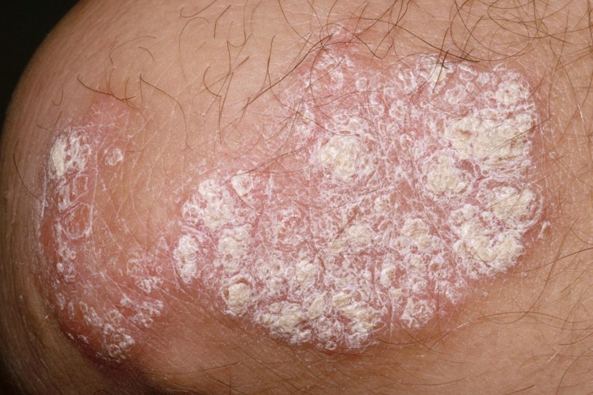 Skin Manifestations of Chronic Hepatitis C Virus Infection