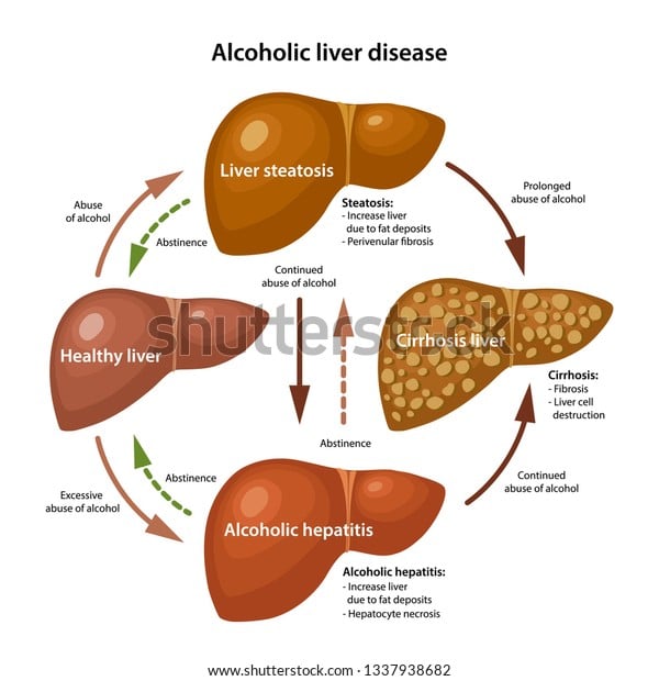 Stages Alcoholic Liver Disease Description Corresponding Stock Vector ...