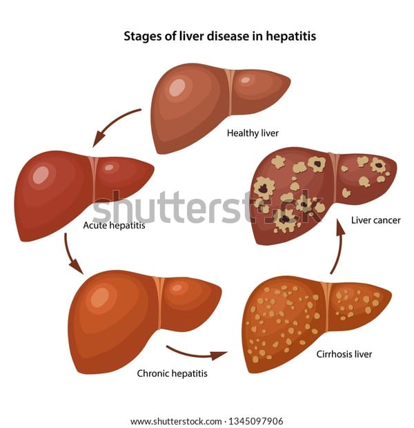 Stages Liver Disease Hepatitis Description Corresponding Stock Vector ...