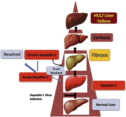 Stages of liver damage. This figure shows how normal healthy liver ...