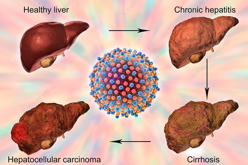 Stages of liver disease in hepatitis C, illustration ...