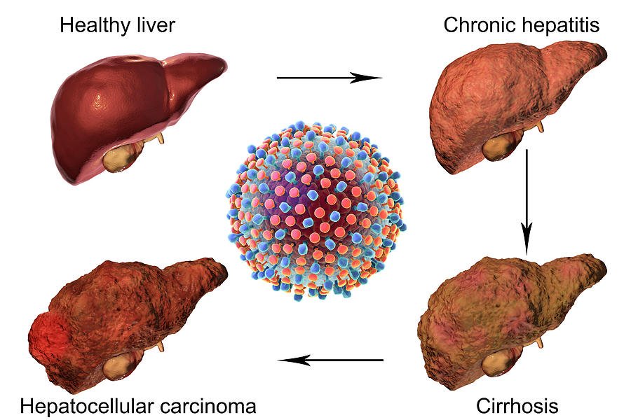 Stages Of Liver Disease In Hepatitis C Photograph by ...