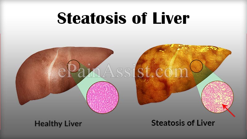 Steatosis of Liver