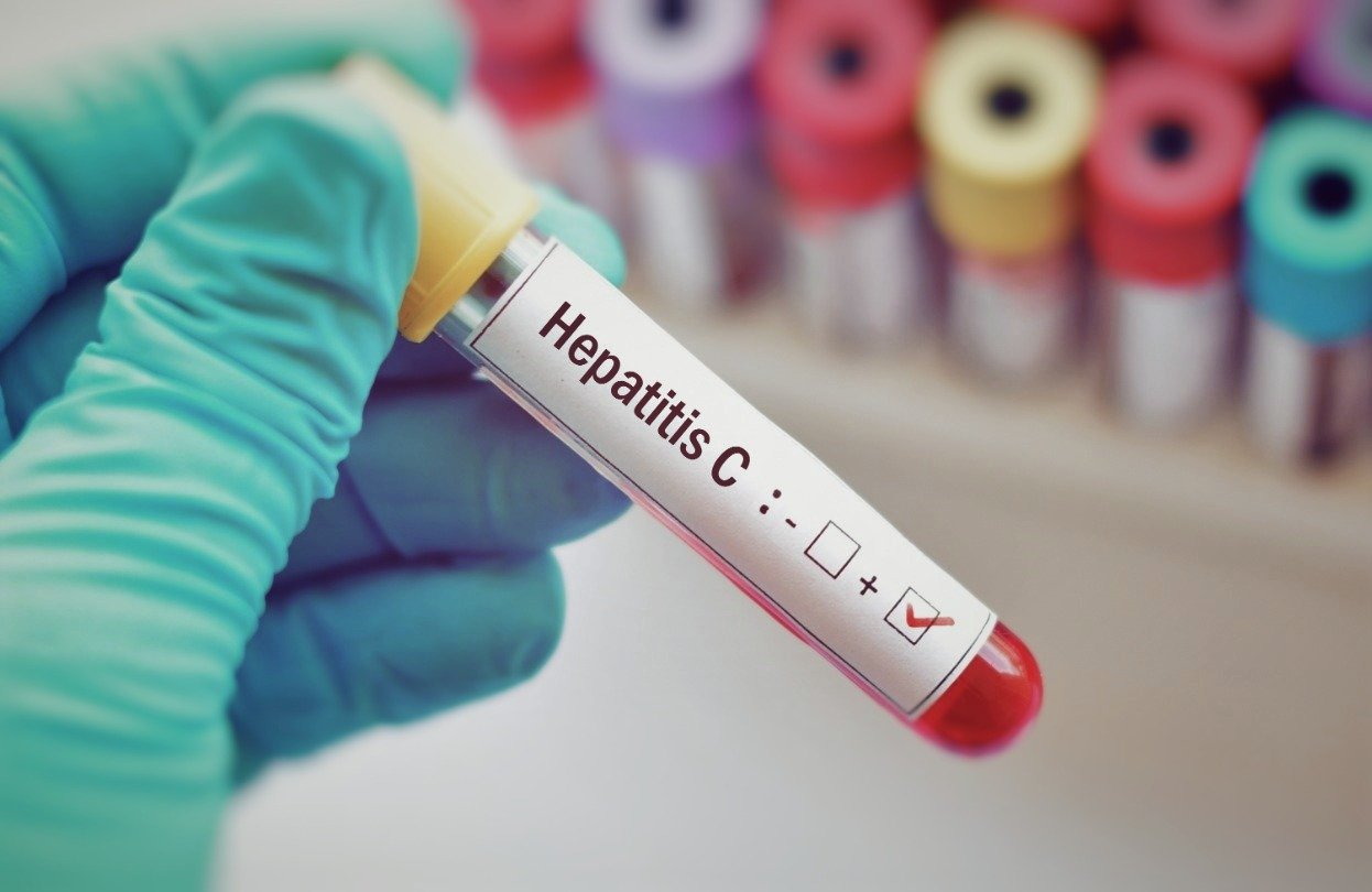 Symptoms of Hepatitis C and its Diagnosis