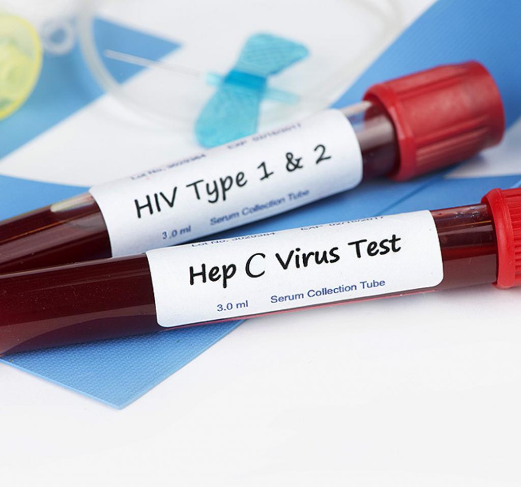 Test hepatitis patients for HIV, expert urges doctors