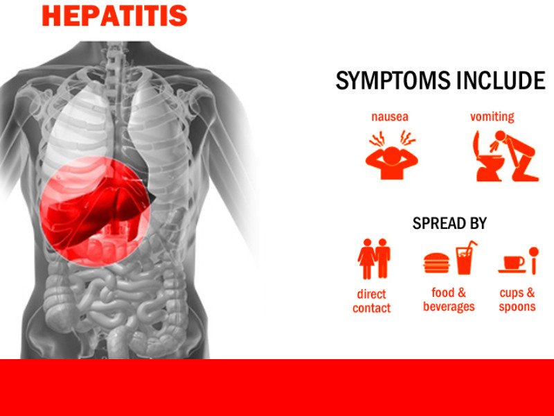 The A, B, C, D and E of Hepatitis