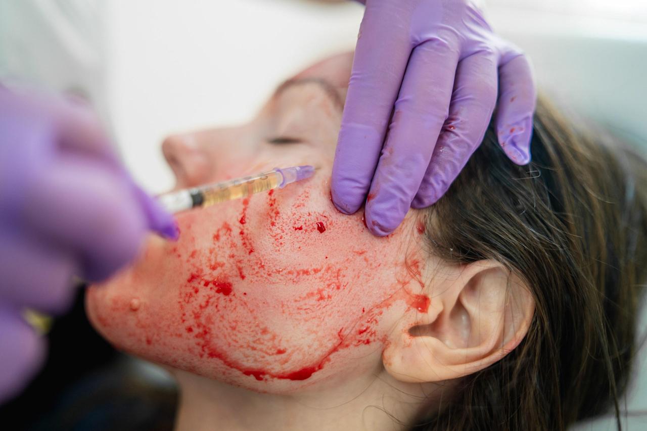 The " Vampire Facial"  May Have Exposed Patients to HIV and ...