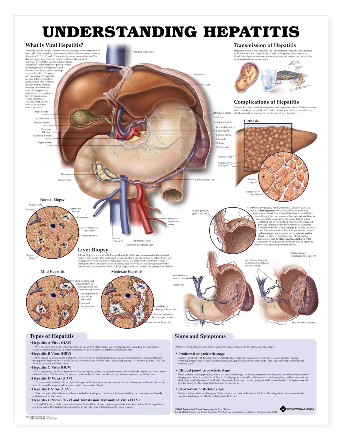 Understanding Hepatitis Chart / Poster
