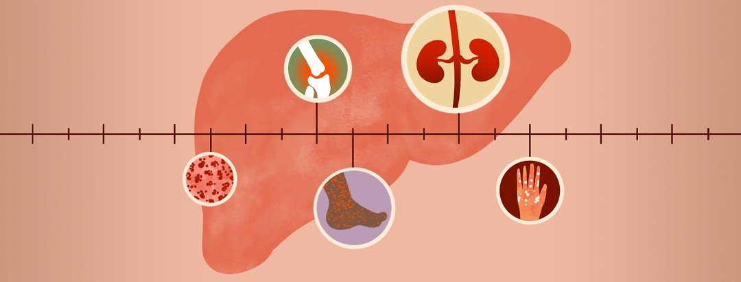 What Are Extrahepatic Manifestations?