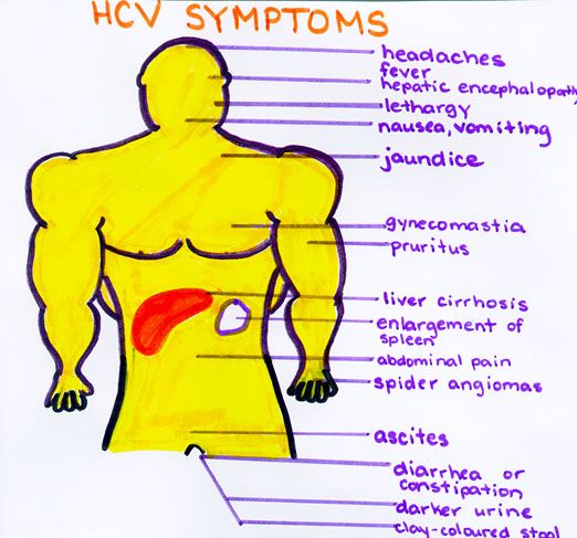 What are the early symptoms of hepatitis C?