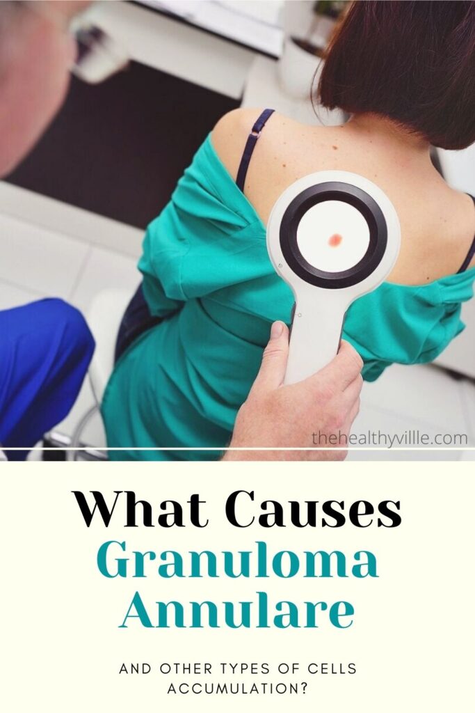 What Causes Granuloma Annulare and Other Types of Cells ...