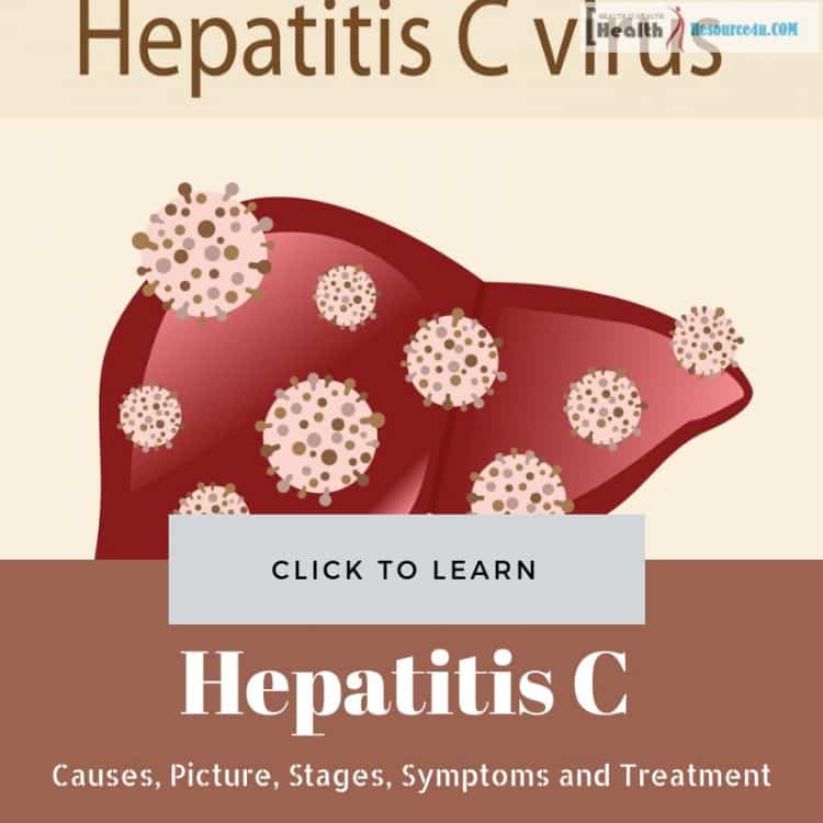 What Causes Hepatitis C : Hepatitis C (infectious liver inflammation ...