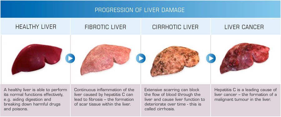What causes most Liver Diseases? alcohol?