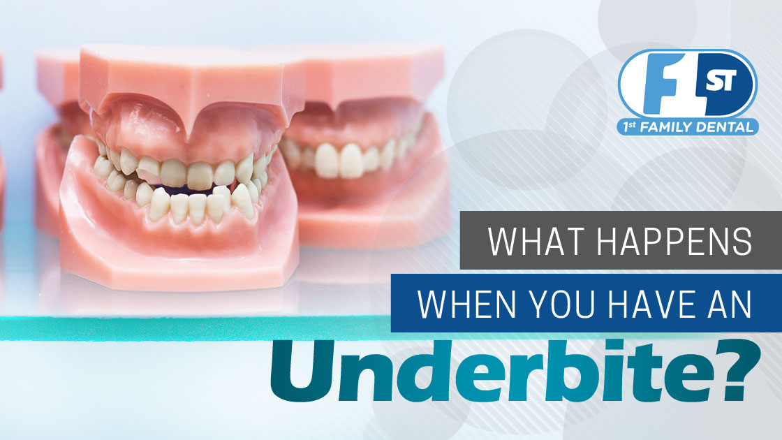 What Happens When You Have an Underbite?