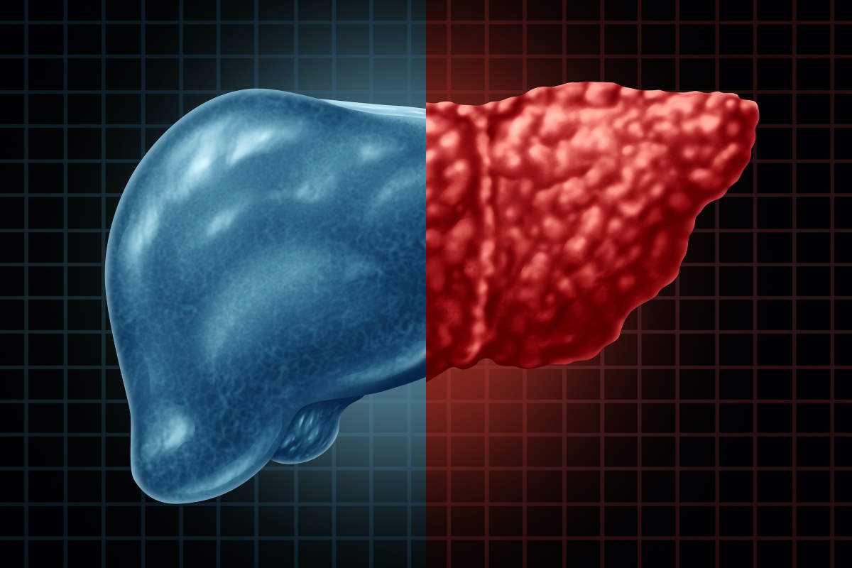 What Hepatitis C and Fatty Liver Disease Have in Common