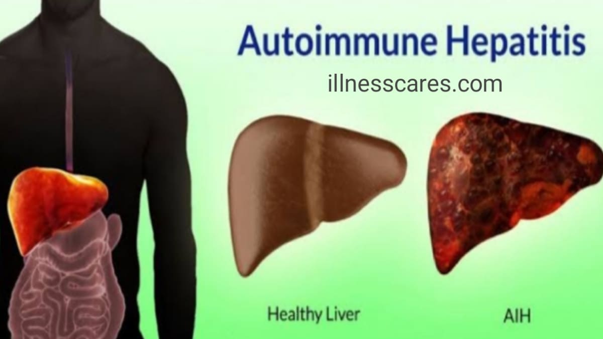what is Autoimmune Hepatitis: causes symptoms and Treatment