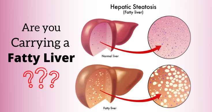 What is Fatty Liver (Steatosis)?