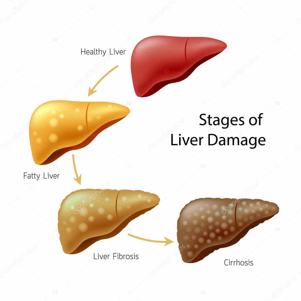 What Is Hepatic Cirrhosis Of The Liver