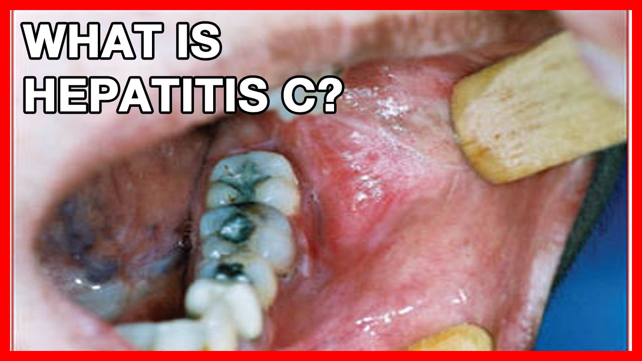 What is Hepatitis c? Transmission, Health Risks, Symptoms ...