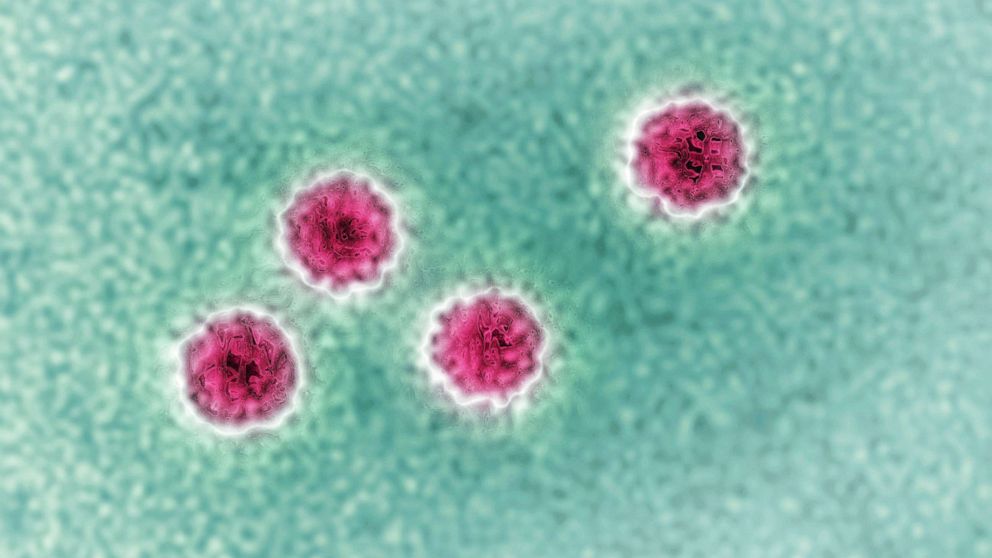What to know about hepatitis A outbreaks in the US